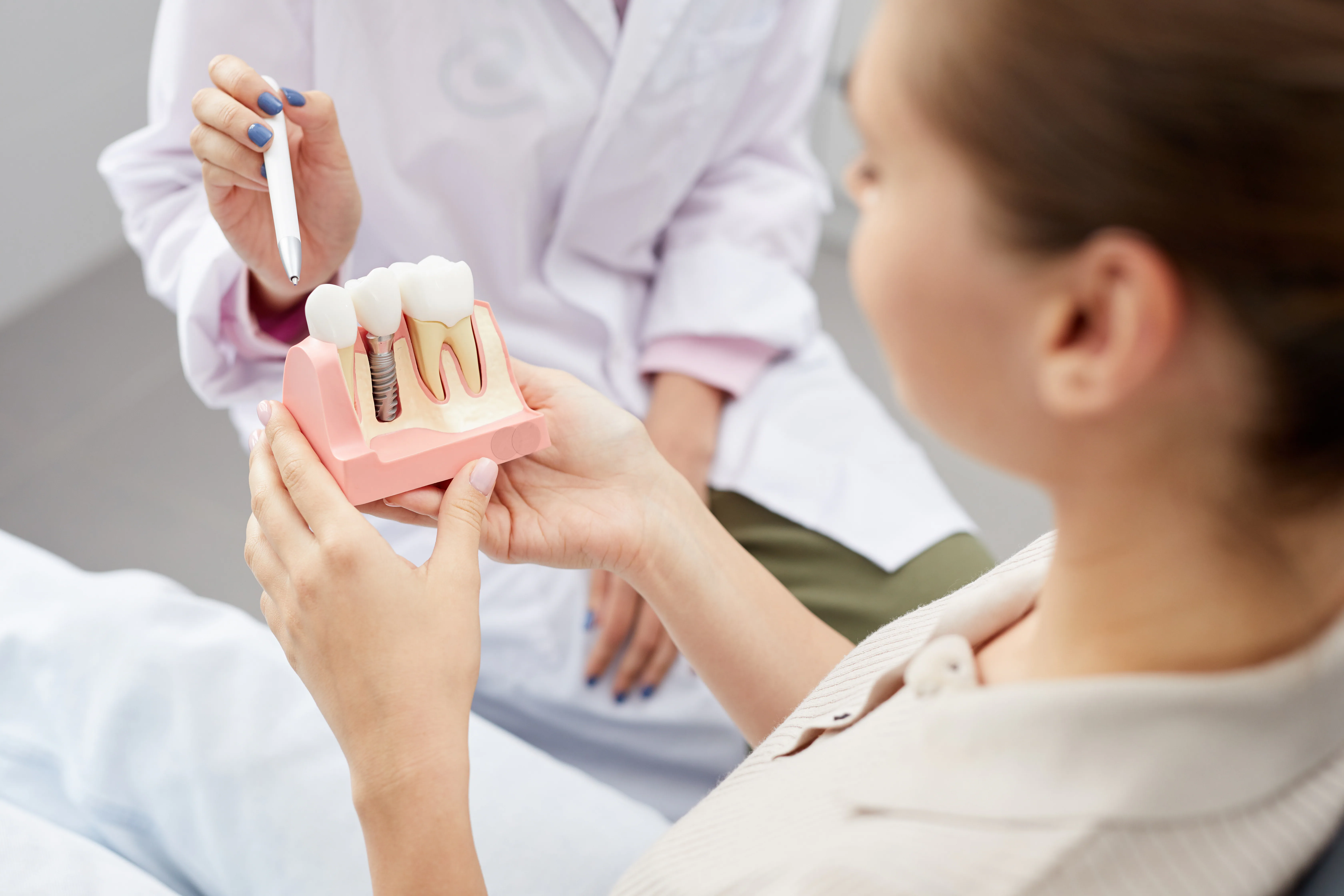 Dental bridges